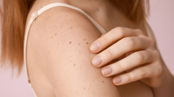 prevenzione tumori cutanei